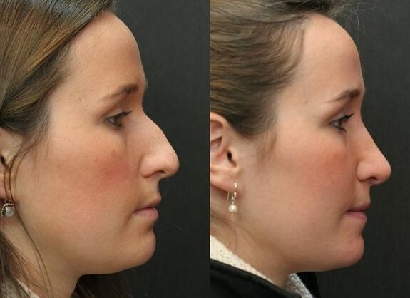 Before and after an unkindly rhinoplasty