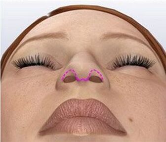 Nasal correction