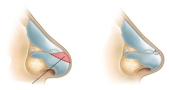Correction of the shape of the nose