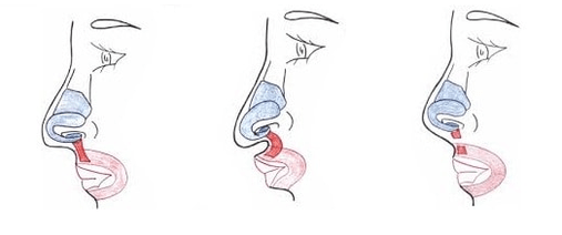 Cutting part of the nasal muscle