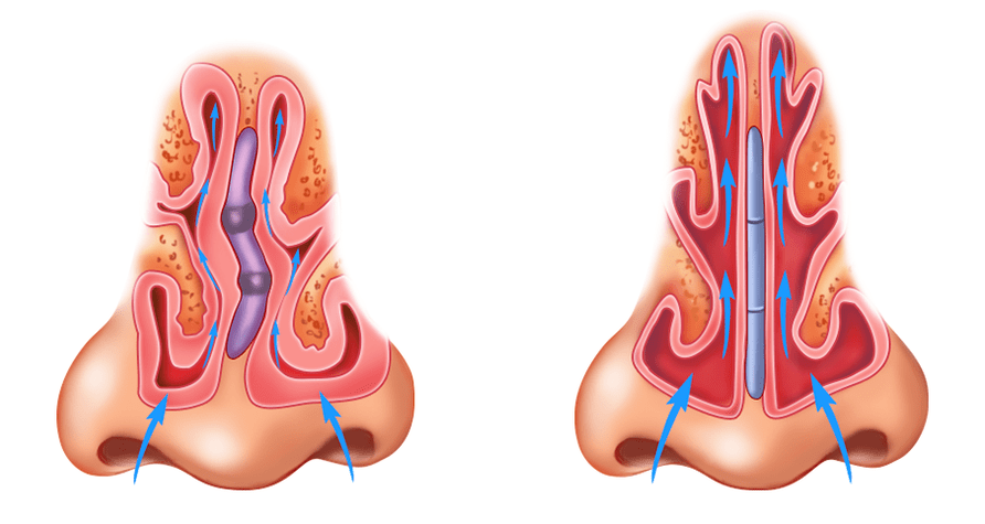 deviation of the nasal septum