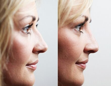 Before and after rhinoplasty with fillers