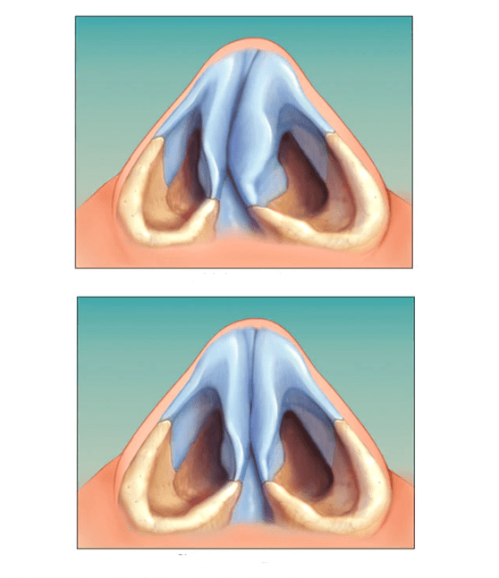 corrected nasal septum