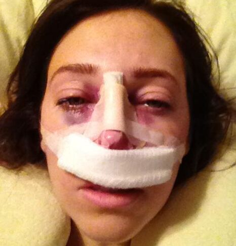 After the operation, a plaster cast is placed on the nose