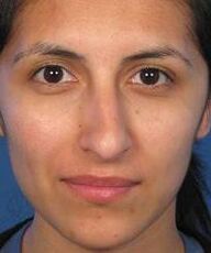An irregular shape of the nose is a reason for plastic surgery
