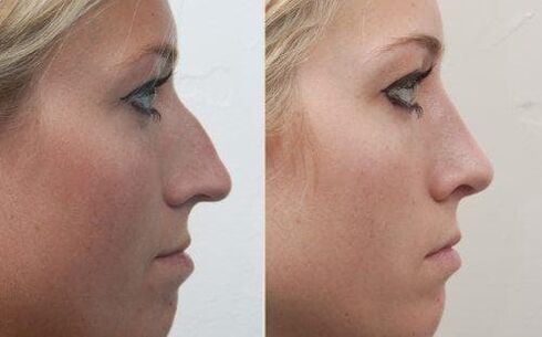 Before and after non-surgical rhinoplasty