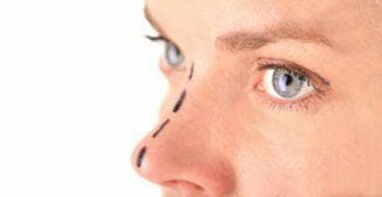 Mark on the nose for inserting cosmetic threads