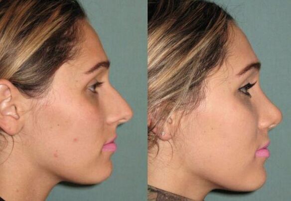 the result of non-injectable rhinoplasty