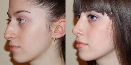 photographs before and after rhinoplasty of the nose