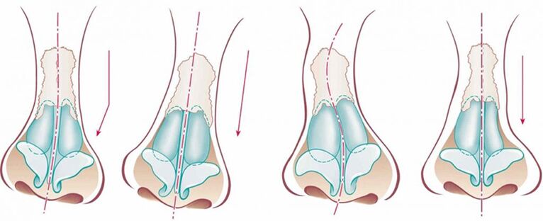 By curving the nasal septum, it deviates from the straight axis