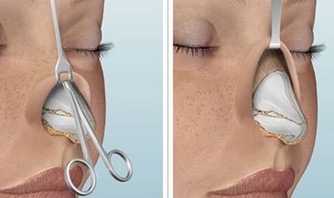 rhinoplasty of the open nose