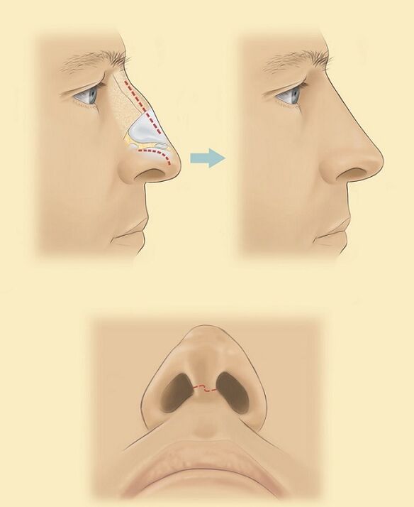 nasal rhinoplasty scheme