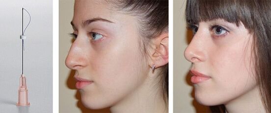 before and after rhinoplasty with mesh threads