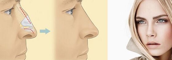 nose shape correction by non-surgical rhinoplasty
