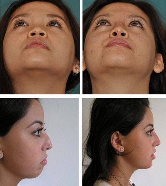 photographs before and after rhinoplasty without surgery