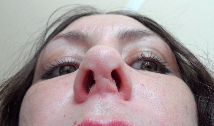 A scar on the nose after a failed rhinoplasty is the reason for the second operation