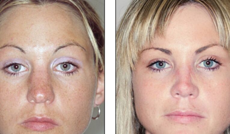 Before and after failed rhinoplasty of the nose