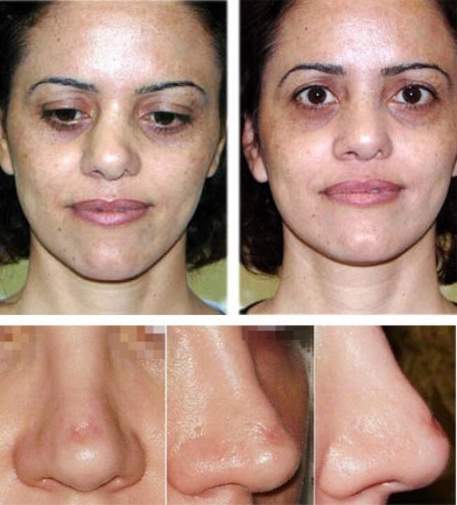 photographs before and after rhinoplasty